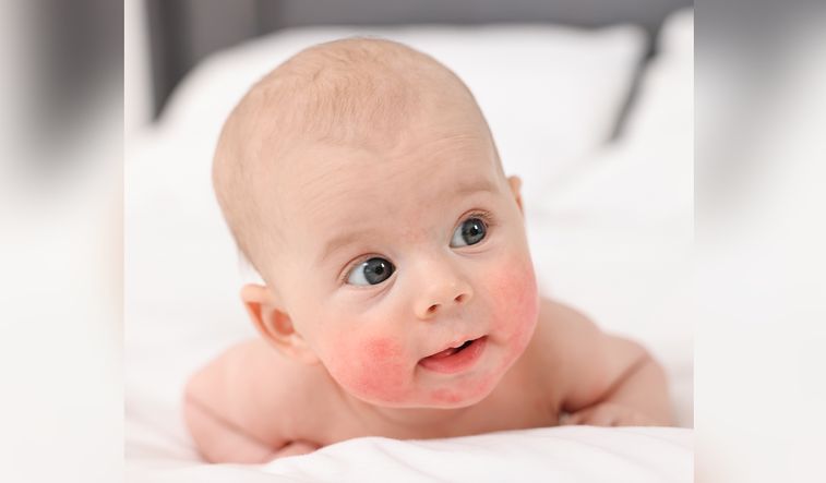 dermatita-atopica-la-copii