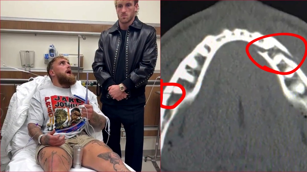 dauna-totala!-jake-paul-a-ajuns-pe-masa-de-operatie-dupa-ce-anthony-joshua-i-a-rupt-mandibula